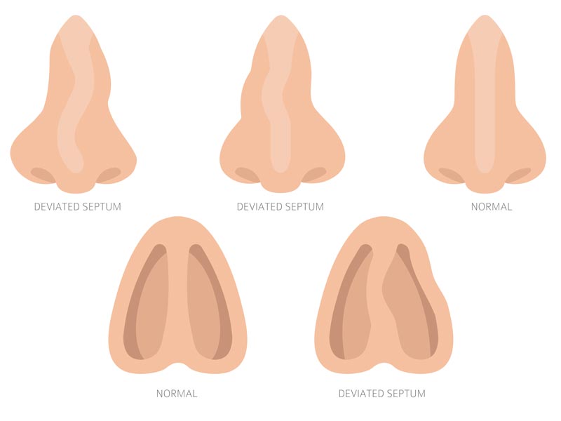 nasal septoplasty illustration
