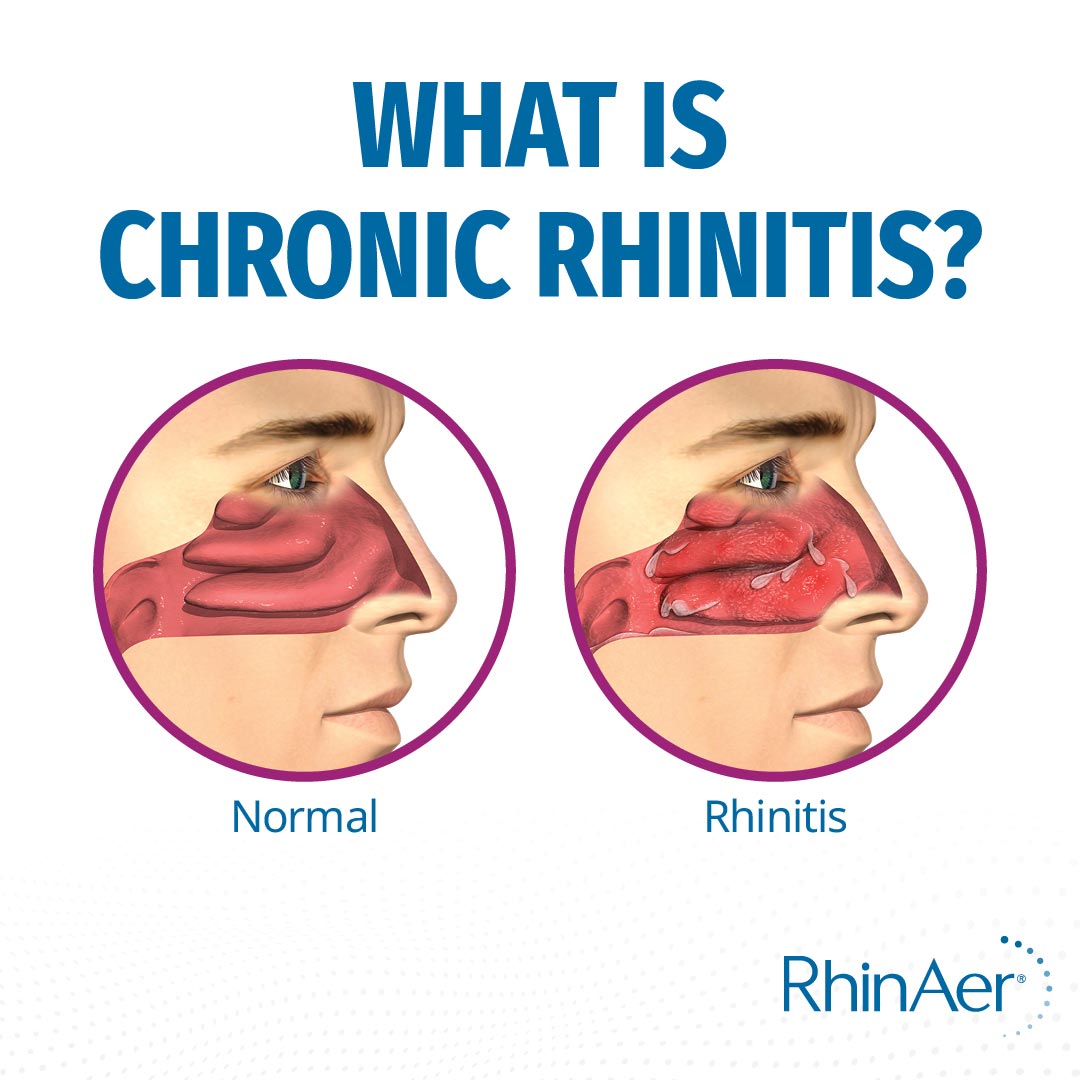 what is chronic rhinitis image